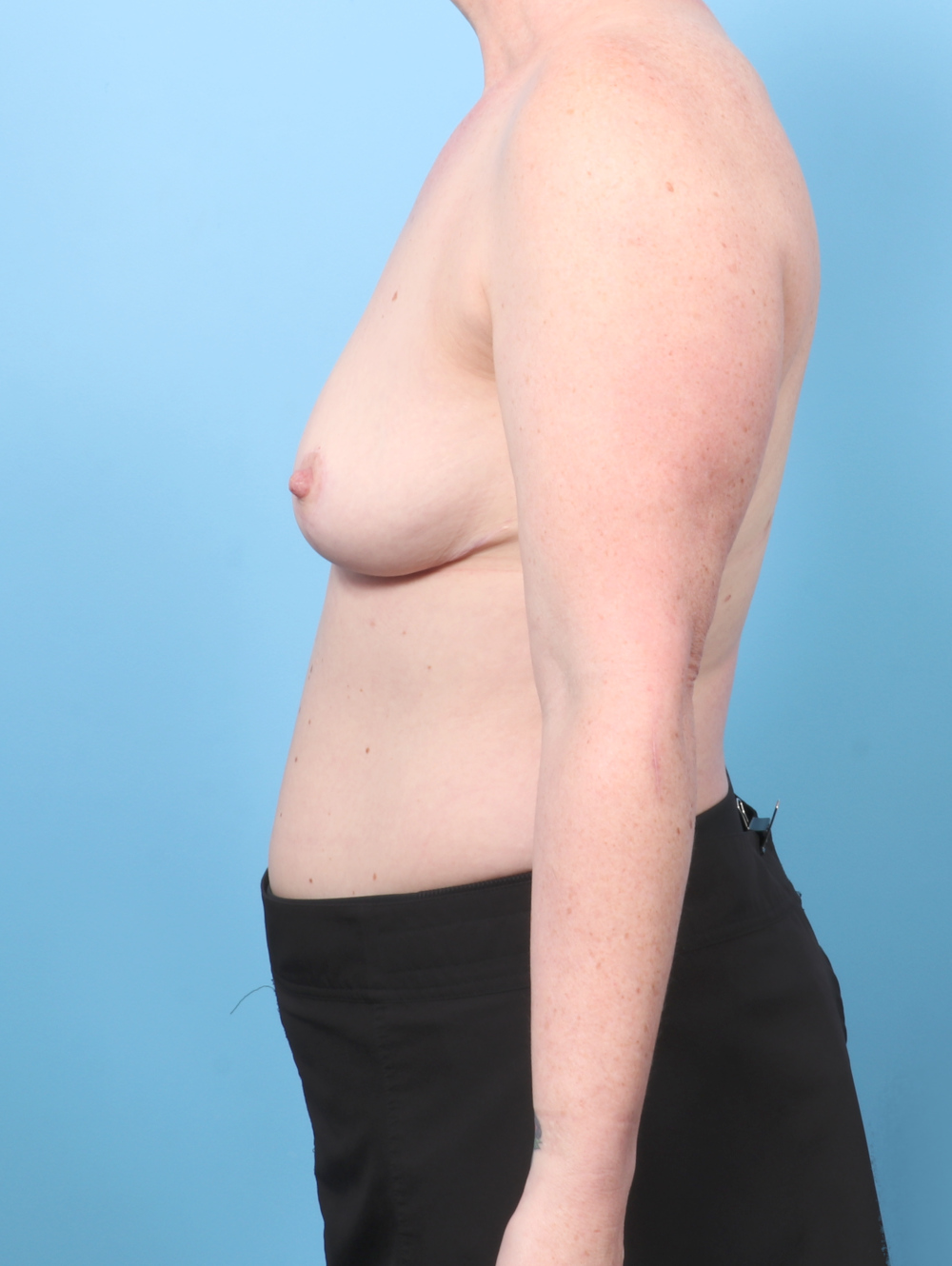 AT-REDUCTION-44YRS-SIDE-AFTER-edited