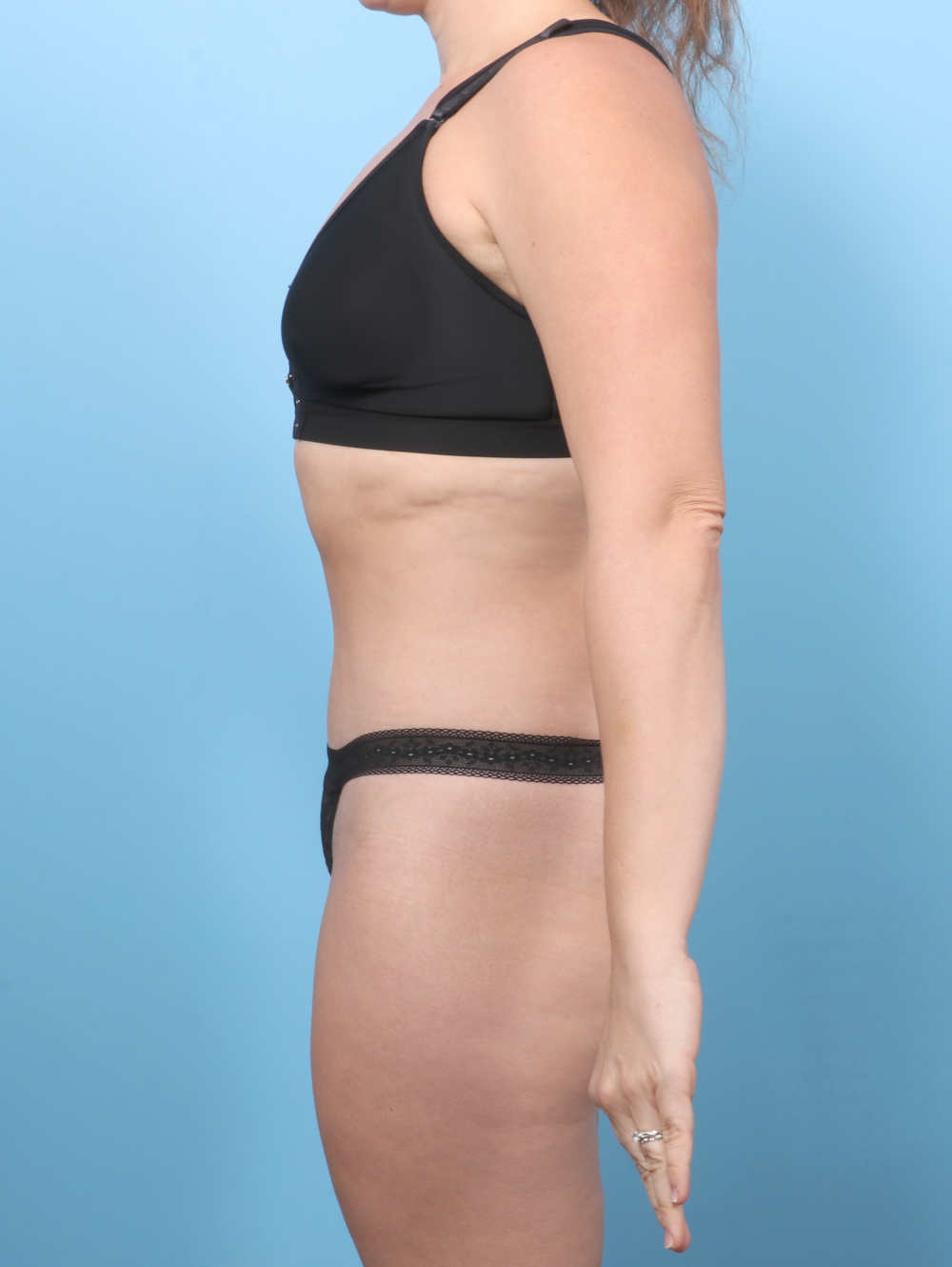 BD-TT-34YRS-SIDE-AFTER-edited