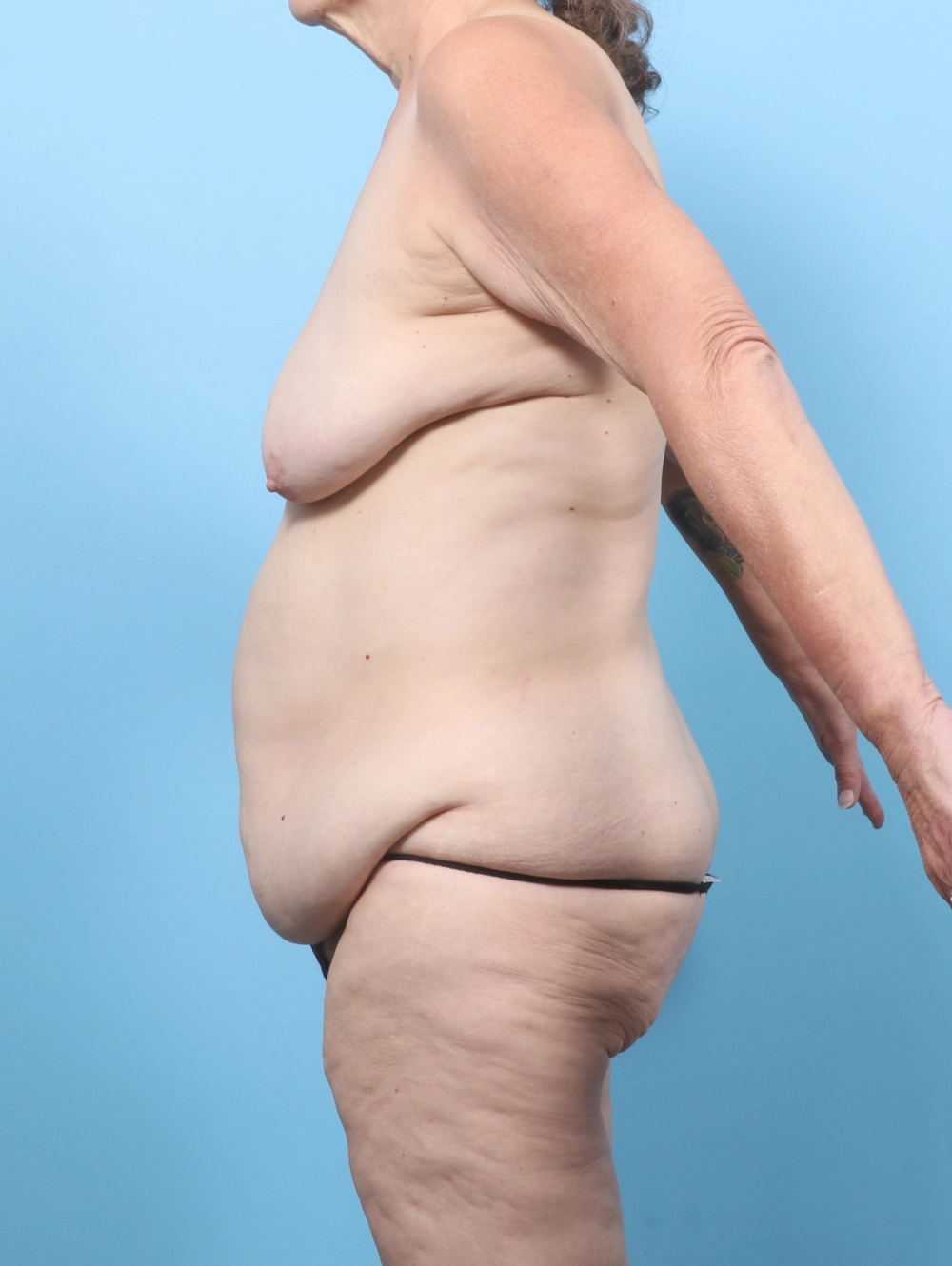 CD-BODYLIFT-MASTO-60YRS-SIDE-BEFORE-edited