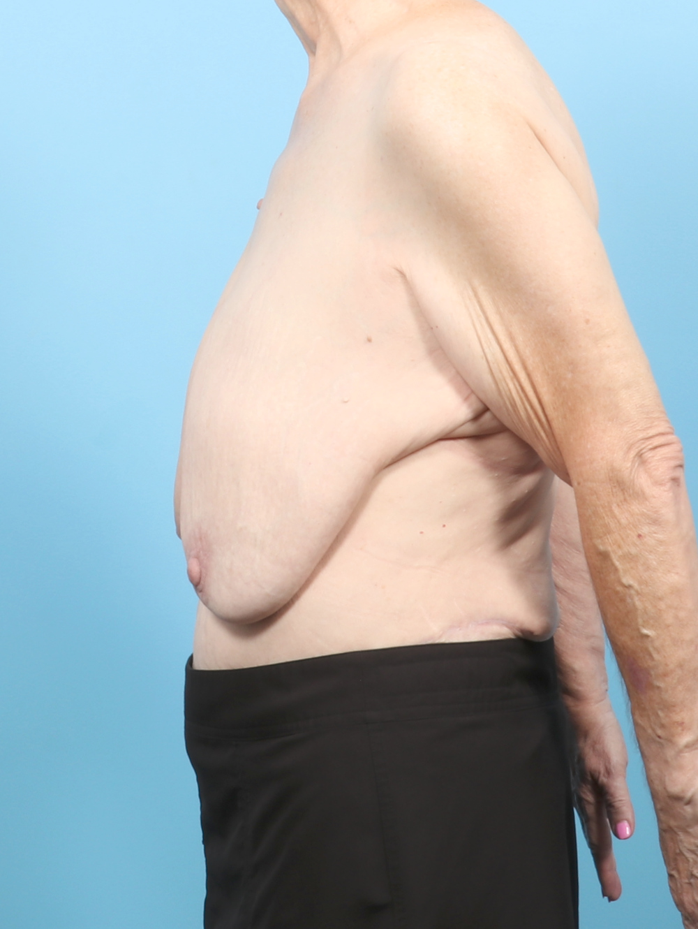 DL-REDUCTION-69YRS-SIDE-BEFORE-EDITED