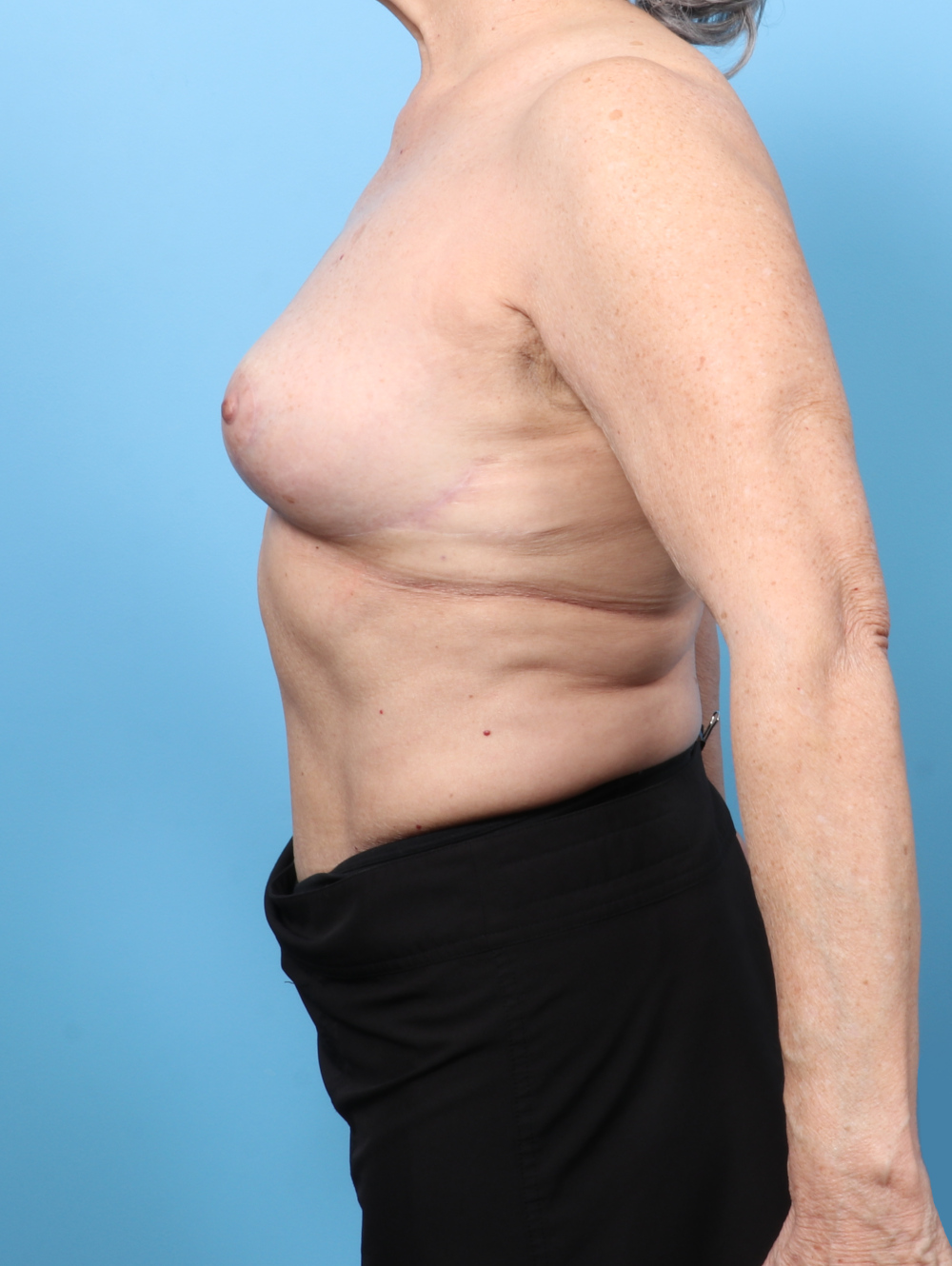 IR-70YRS-MASTOREMOVAL-AXLIPO-SIDE-AFTER-edited