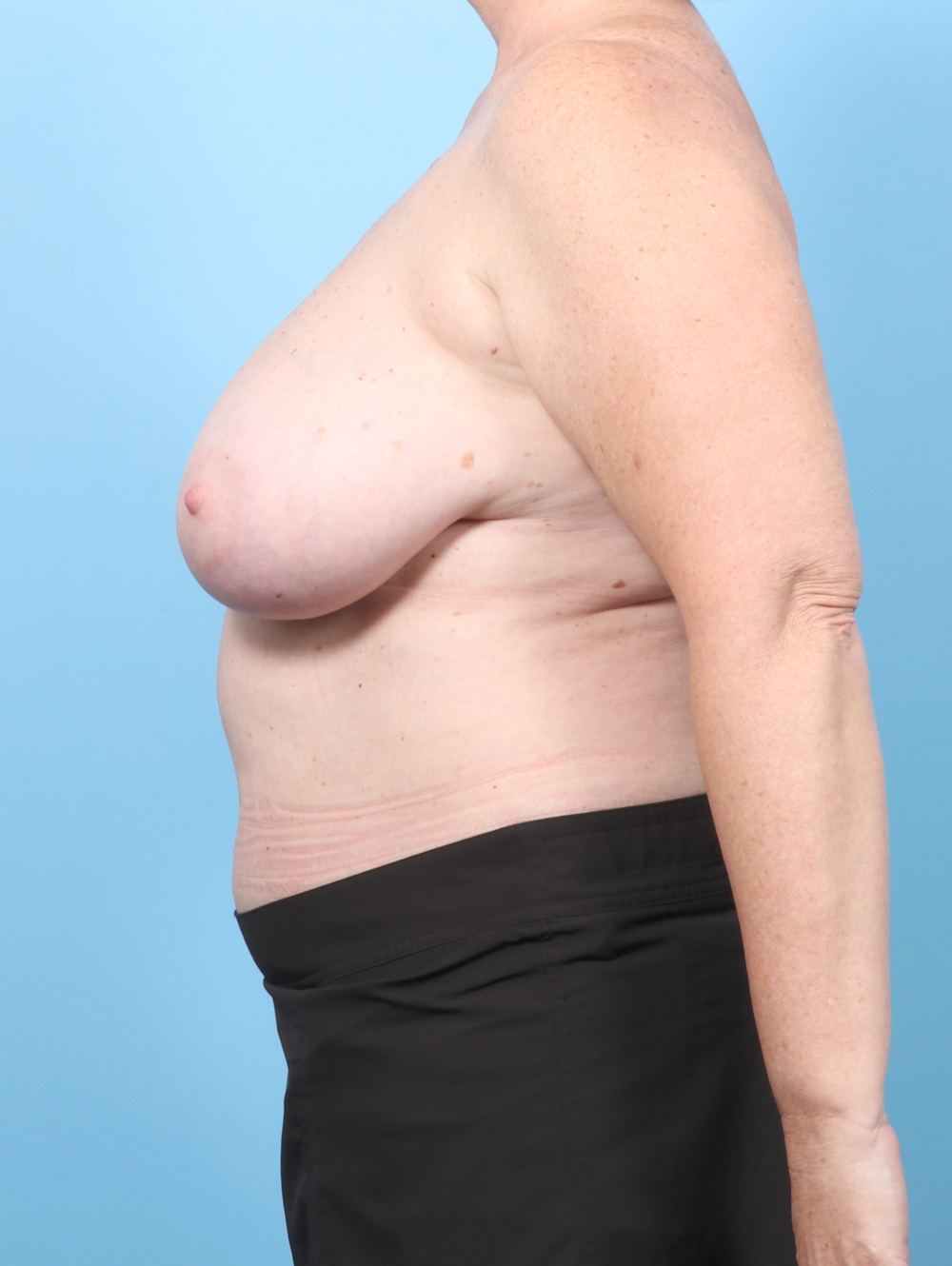 KZ-REDUCTION-58YRS-SIDE-BEFORE-edited