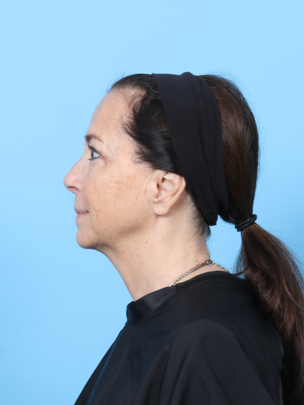 MG-UBLEPH-64YRS-SIDE-AFTER-EDITED