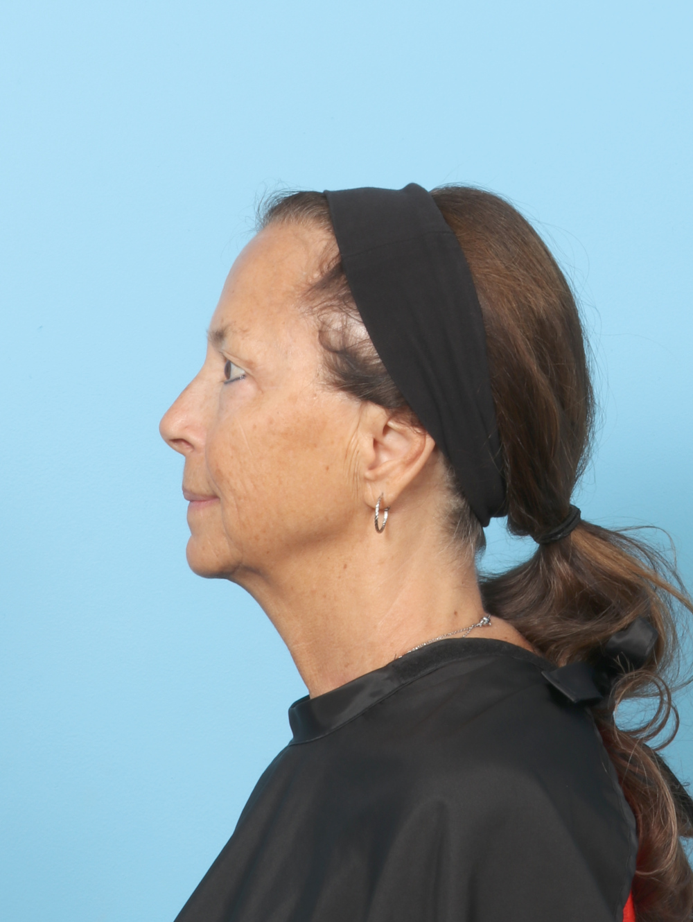 MG-UBLEPH-64YRS-SIDE-BEFORE-EDITED