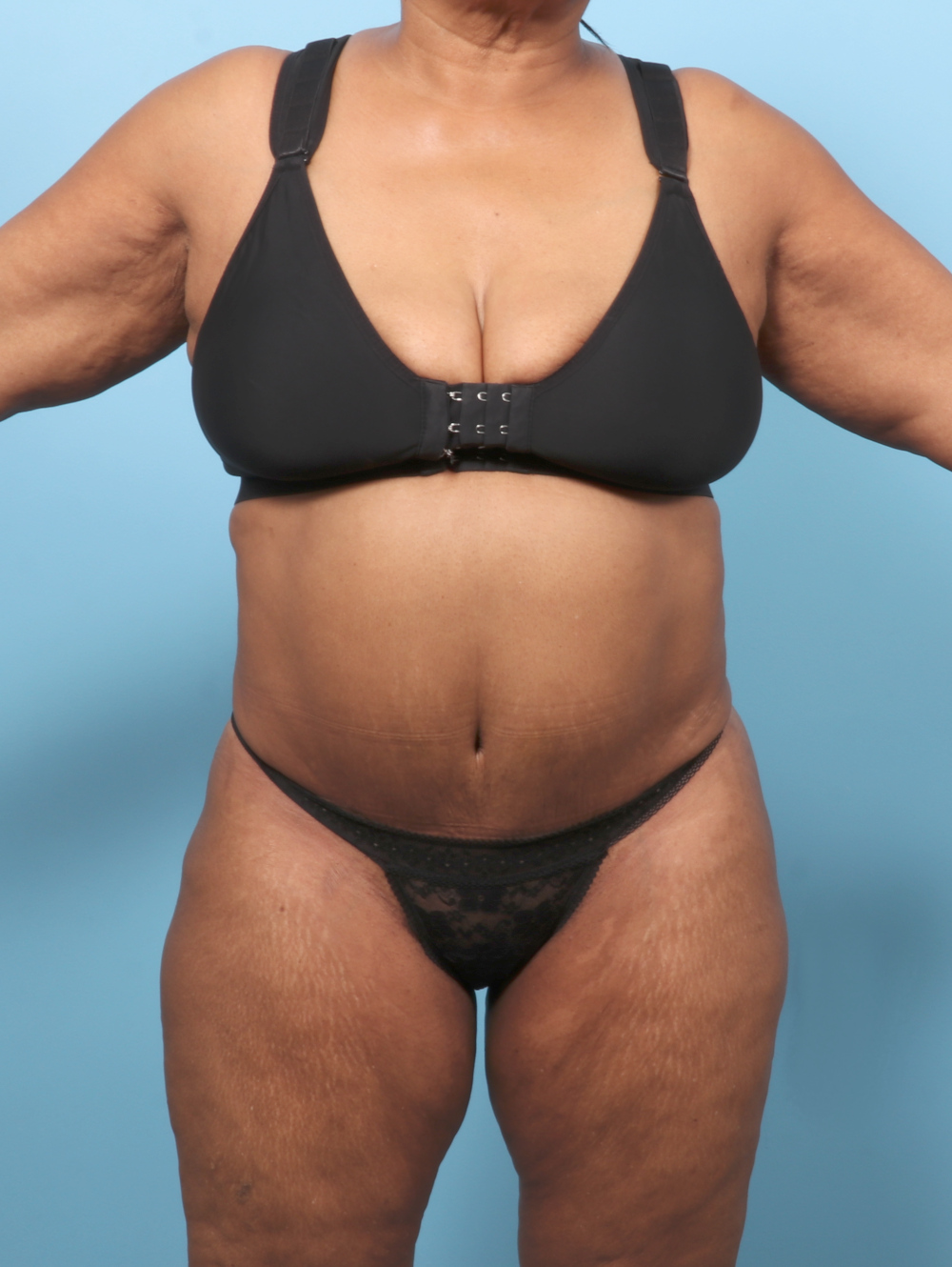 OP-TT-BSLIPO-63YRS-FRONT-AFTER-edited