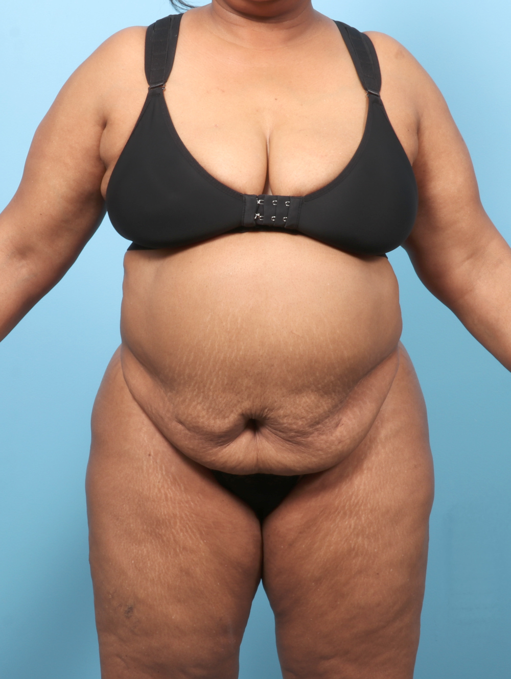 OP-TT-BSLIPO-63YRS-FRONT-BEFORE-edited