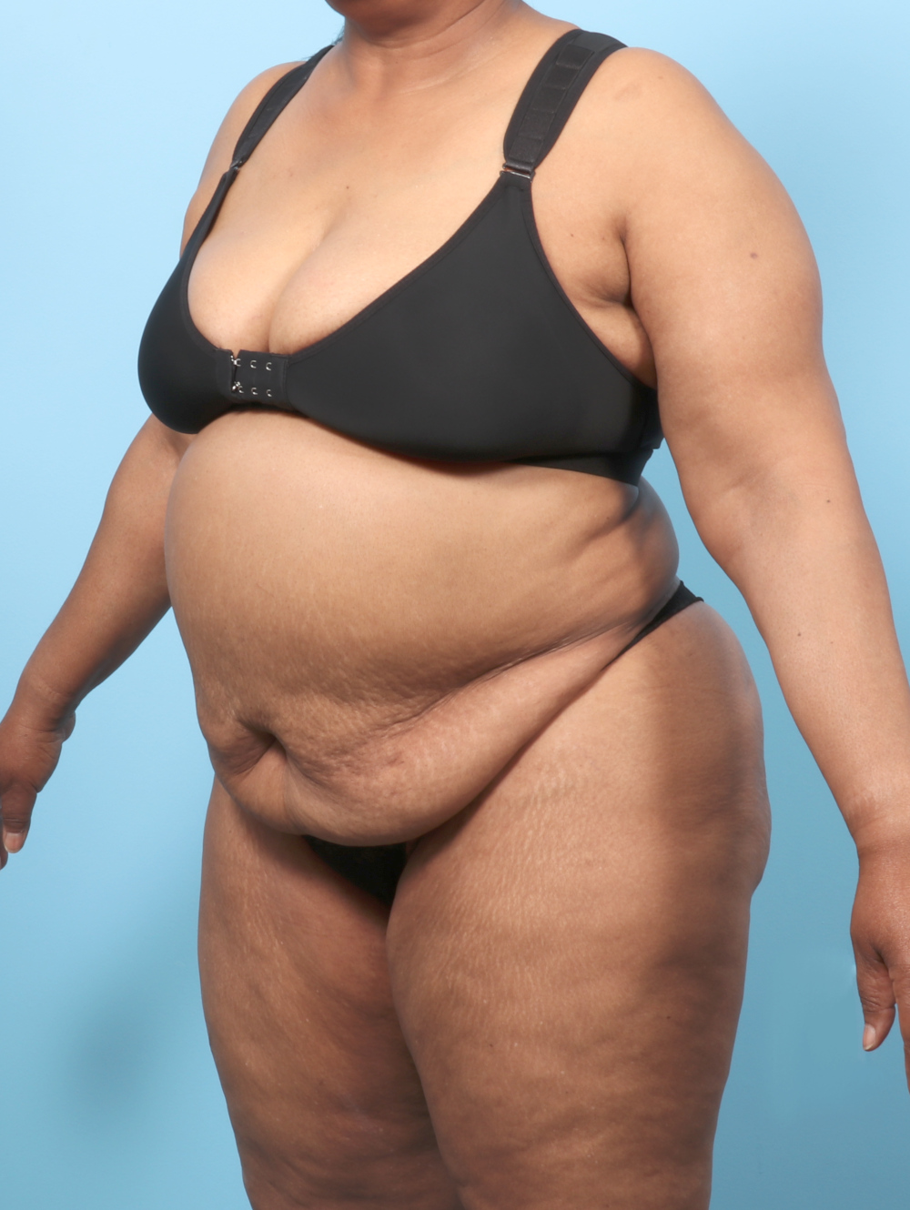 OP-TT-BSLIPO-63YRS-OBL-BEFORE-edited