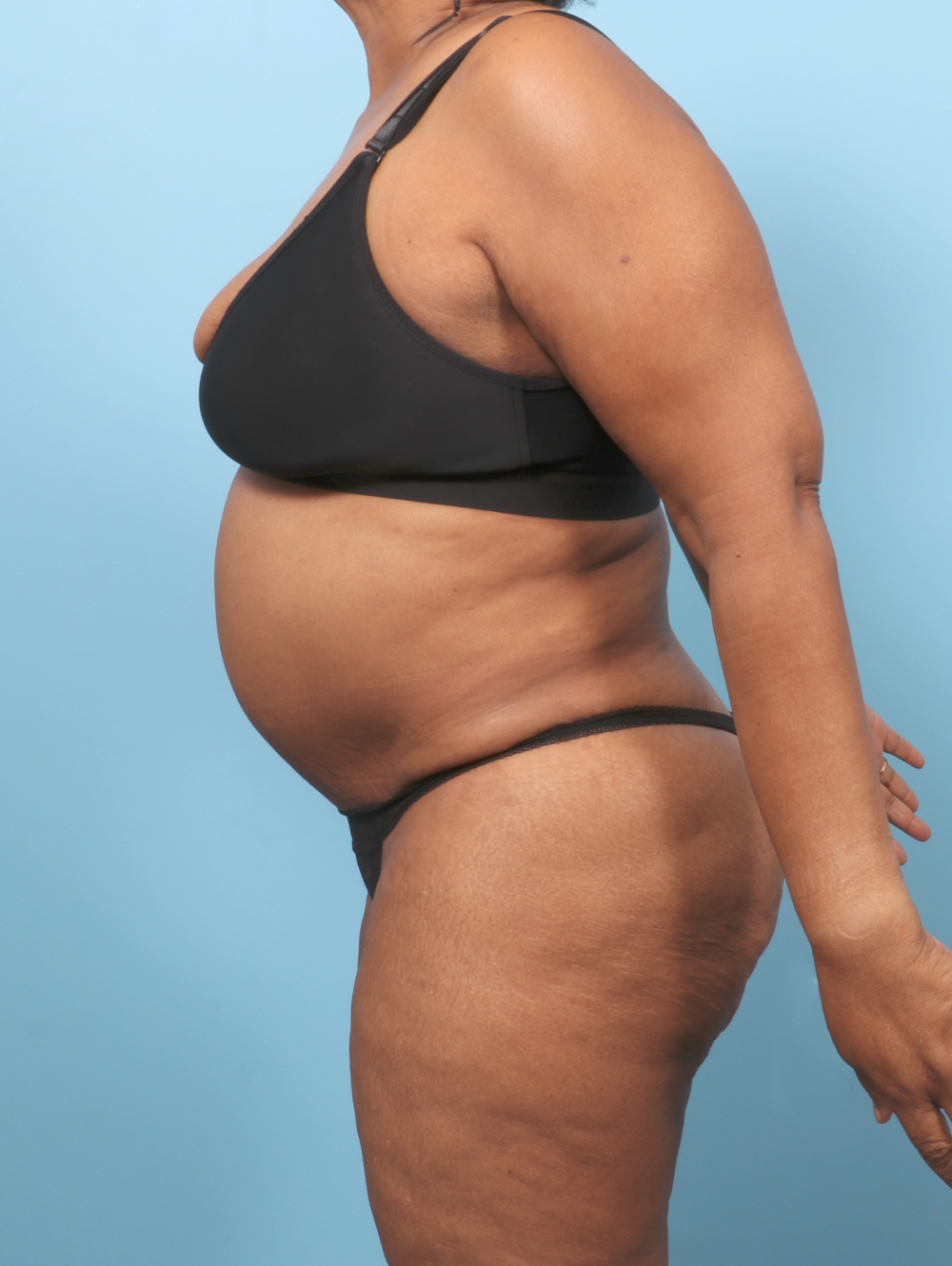 OP-TT-BSLIPO-63YRS-SIDE-AFTER-edited