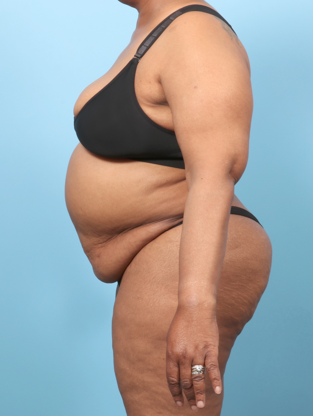 OP-TT-BSLIPO-63YRS-SIDE-BEFORE-edited