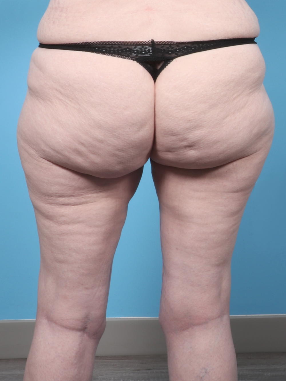 PV-THIGHLIPO-60YRS-BACK-AFTER-edited