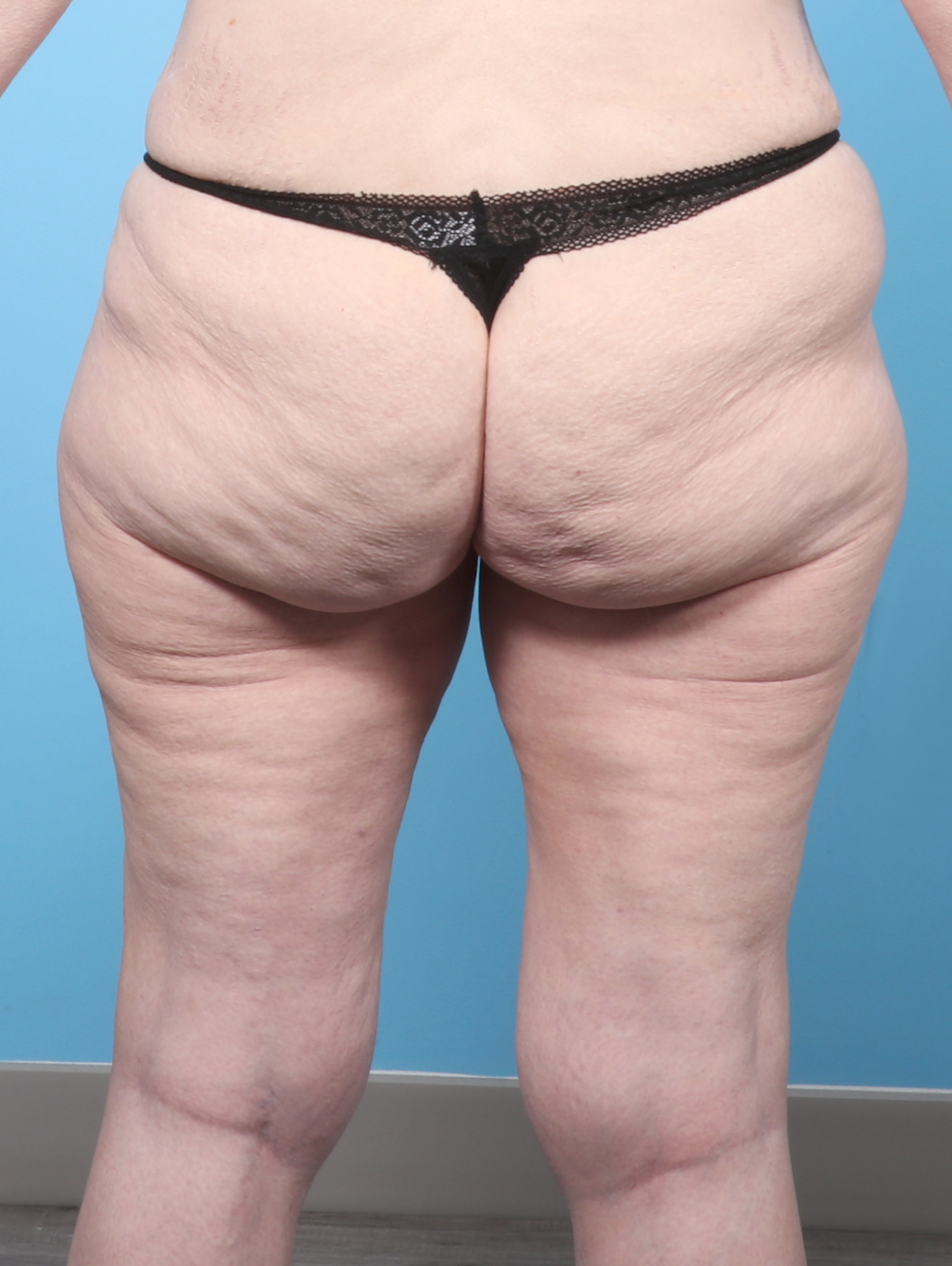 PV-THIGHLIPO-60YRS-BACK-BEFORE-edited