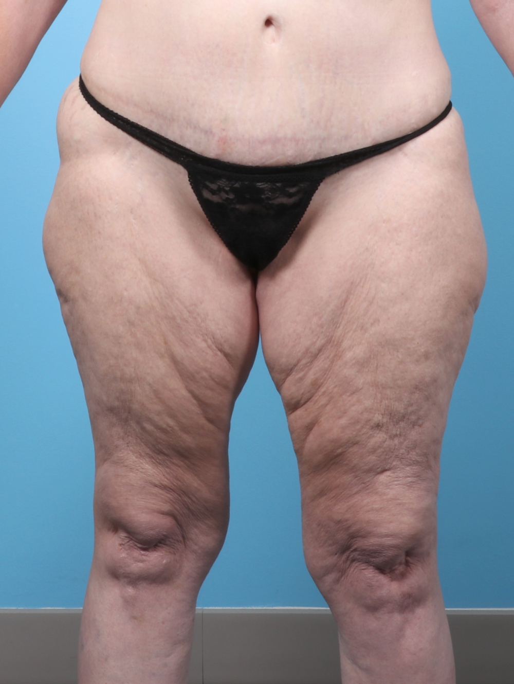 PV-THIGHLIPO-60YRS-FRONT-BEFORE-edited