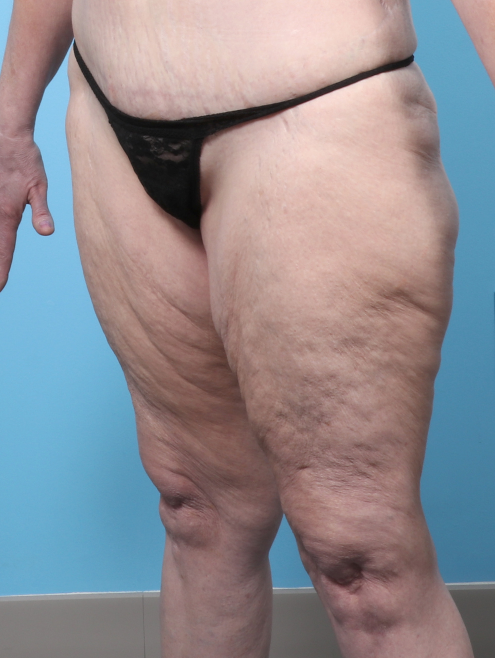 PV-THIGHLIPO-60YRS-OBL-BEFORE-edited