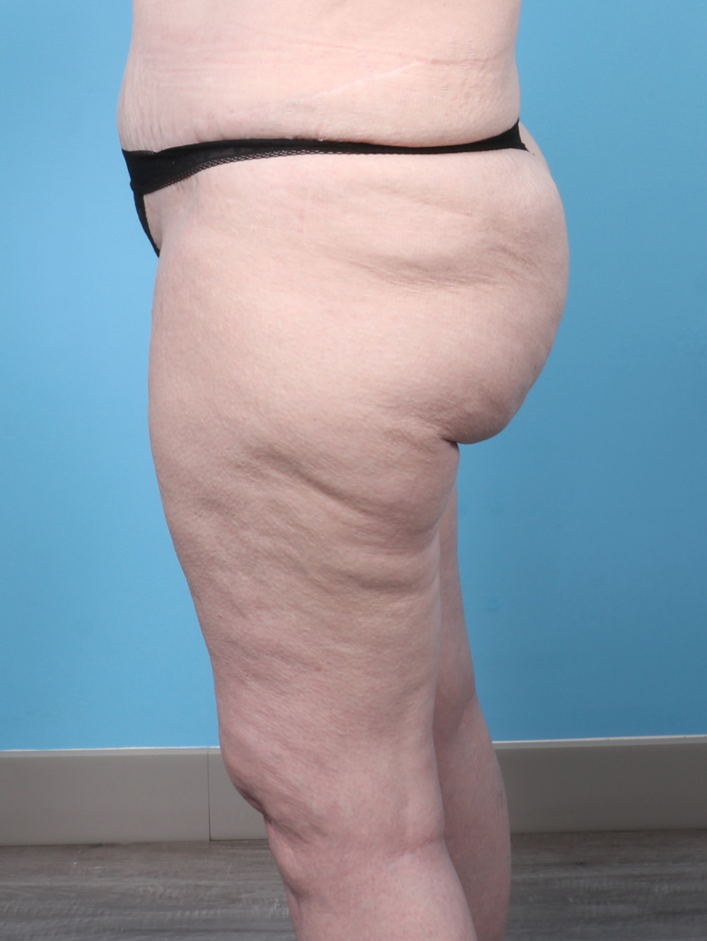 PV-THIGHLIPO-60YRS-SIDE-AFTER-edited