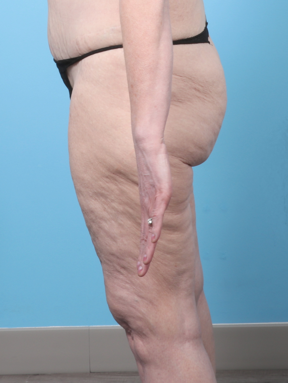 PV-THIGHLIPO-60YRS-SIDE-BEFORE-edited