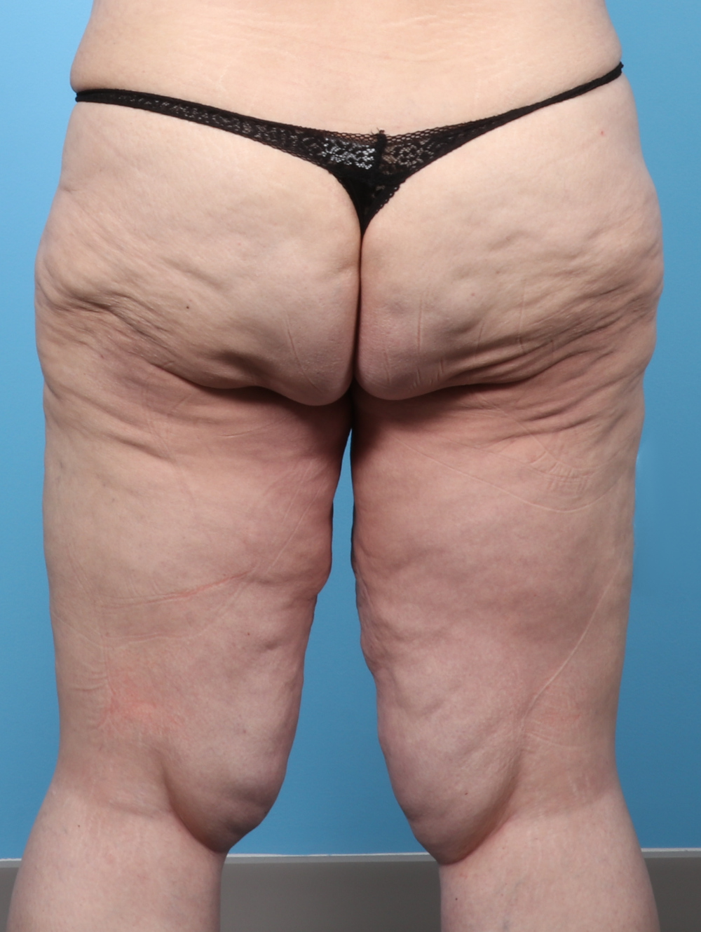 VC-THIGHLIFT-47YRS-BACK-BEFORE-edited