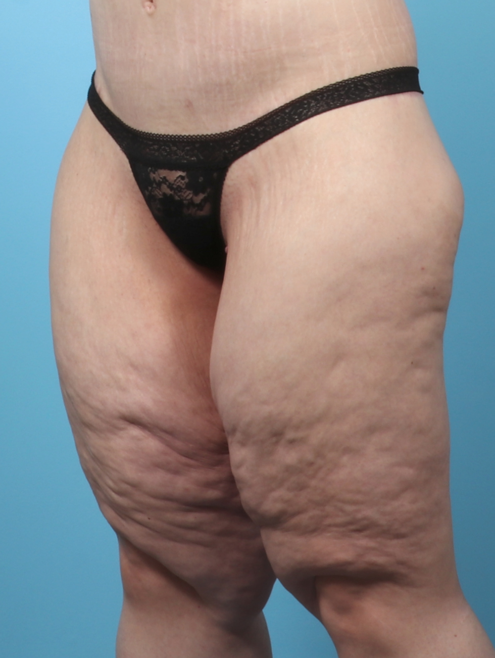 VC-THIGHLIFT-47YRS-OBL-BEFORE-edited