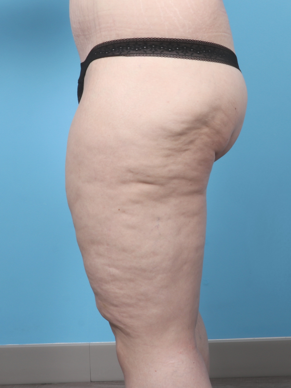 VC-THIGHLIFT-47YRS-SIDE-AFTER-edited