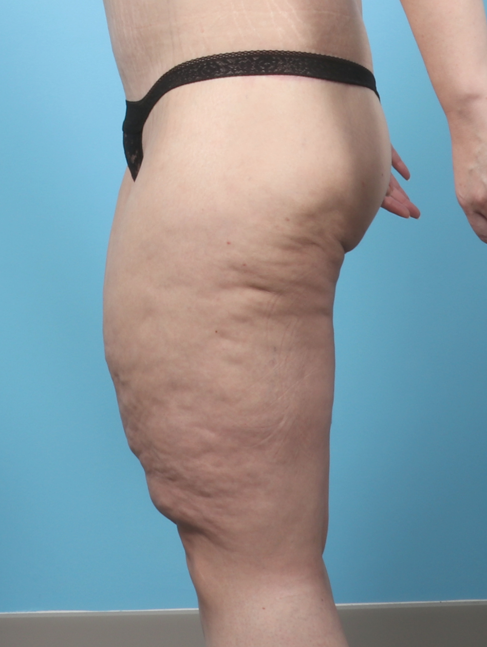 VC-THIGHLIFT-47YRS-SIDE-BEFORE-edited