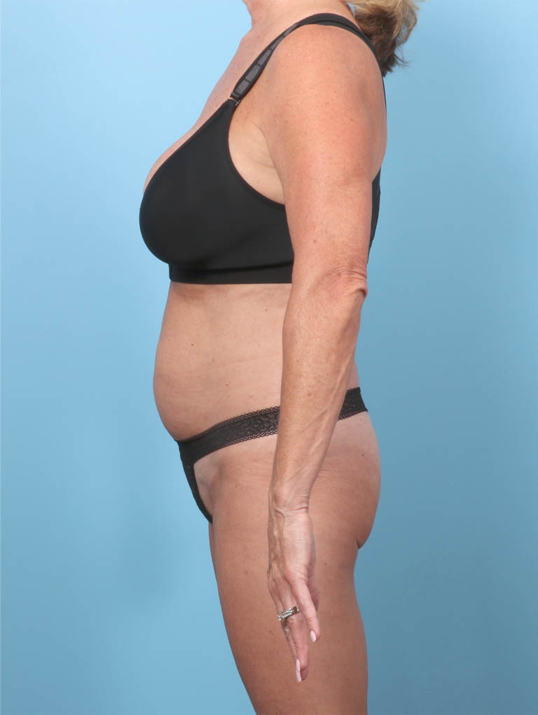 1_0014_DS-TT-BSLIPO-57YRS-SIDE-BEFORE-edited.JPG