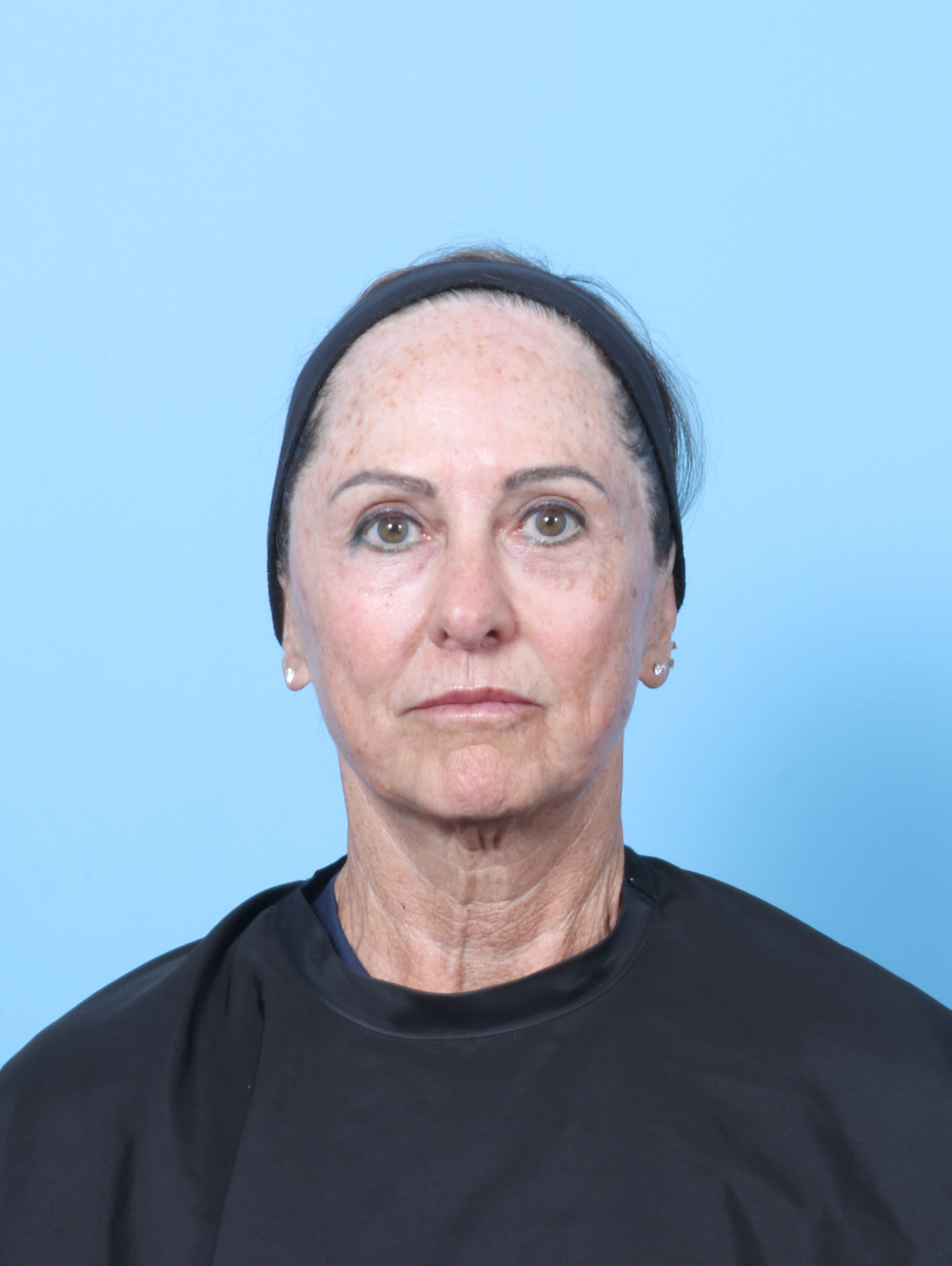 BC-BULLHORN-LASER-FATTRANS-67YRS-FRONT-AFTER-edited