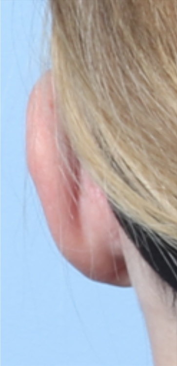 CD OTOPLASTY 13 YEARS BACK AFTER