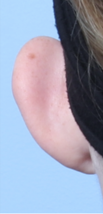CD OTOPLASTY 13 YEARS BACK BEFORE
