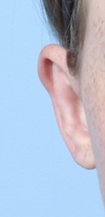 CD OTOPLASTY 13 YEARS FRONT AFTER