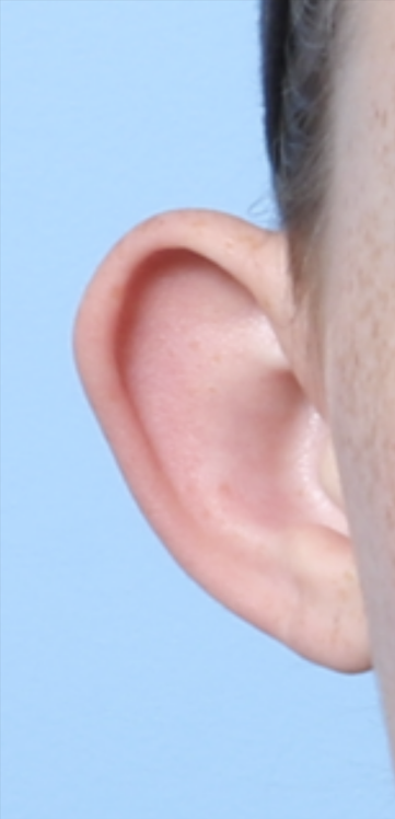CD OTOPLASTY 13 YRS FRONT BEFORE