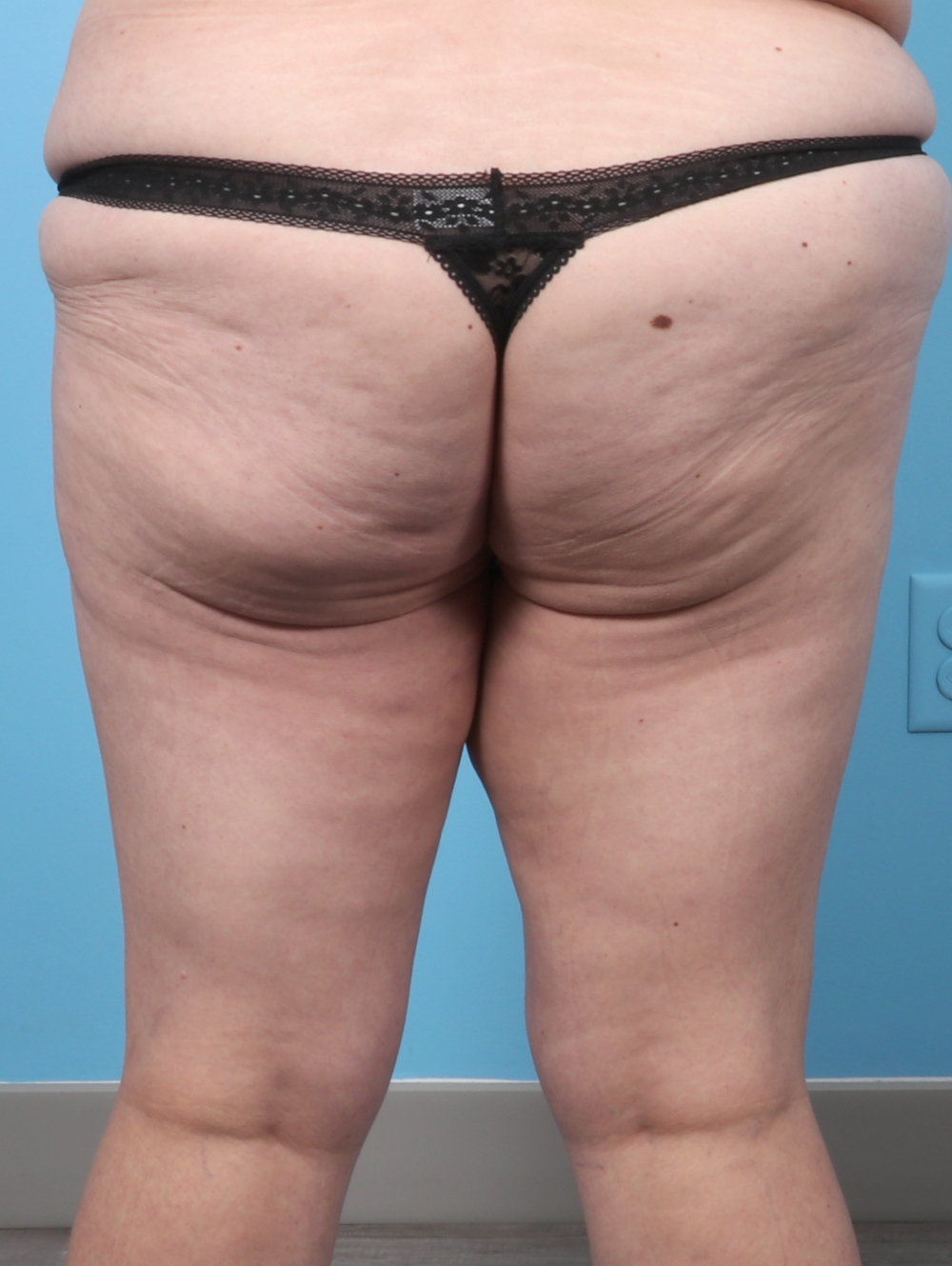 KB-THIGHLIFT-44YRS-BACK-AFTER-EDITED