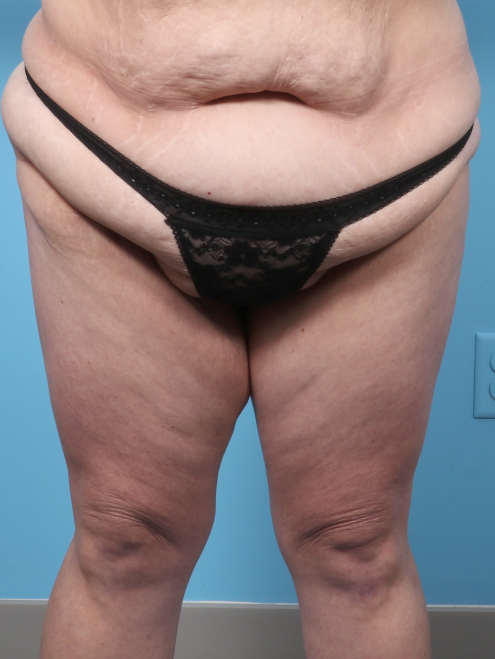 KB-THIGHLIFT-44YRS-FRONT-AFTER-EDITED