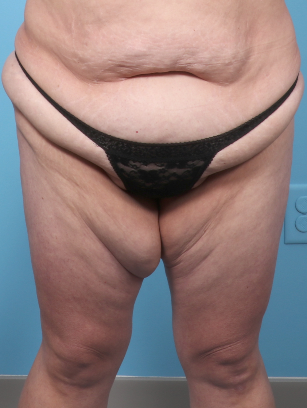 KB-THIGHLIFT-44YRS-FRONT-BEFORE-EDITED