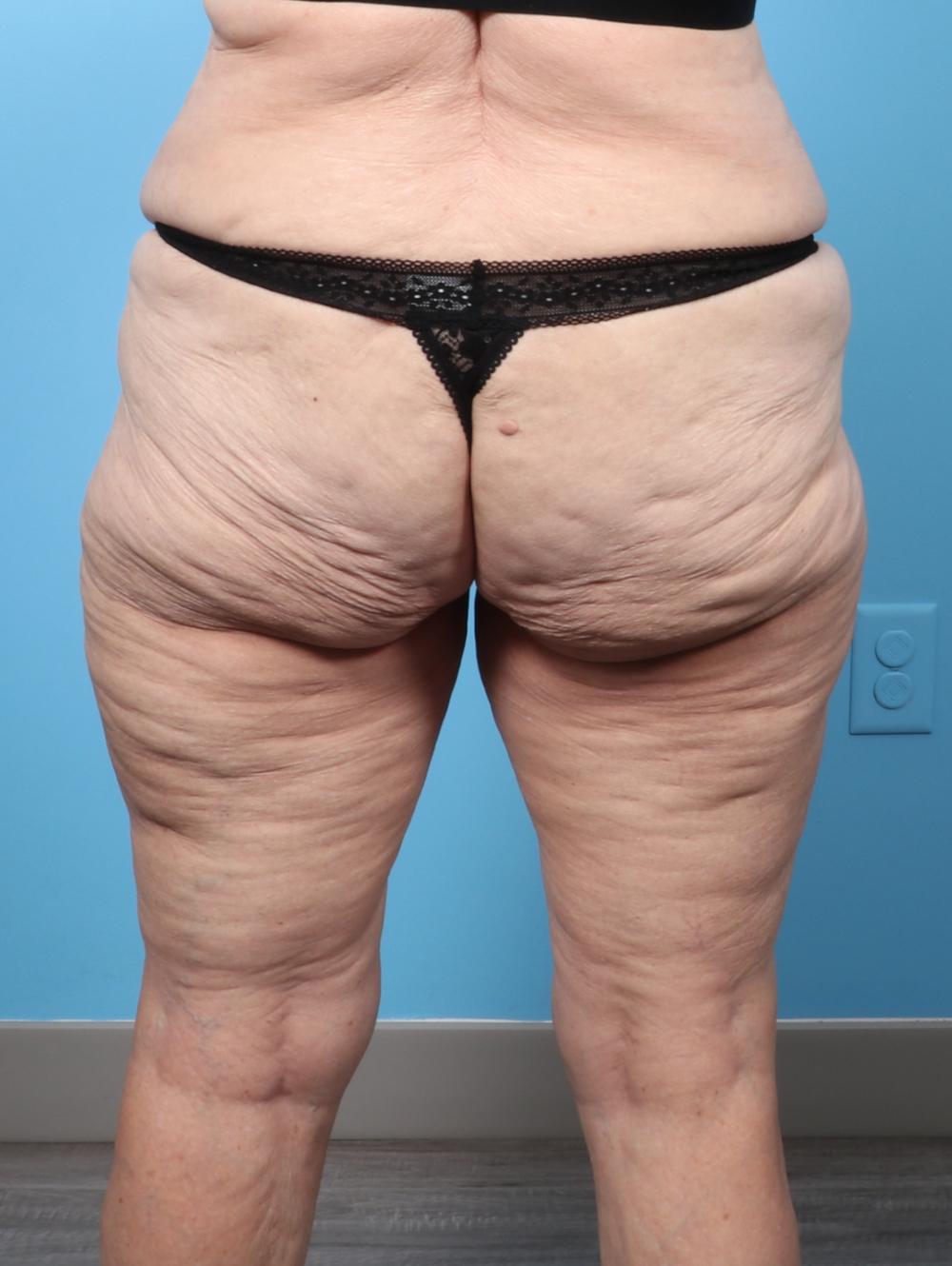 SC-THIGHLIPO-70YRS-BACK-AFTER-edited