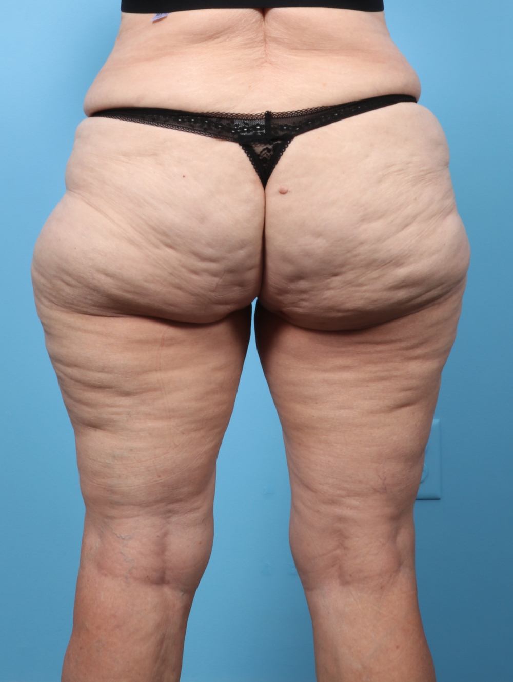 SC-THIGHLIPO-70YRS-BACK-BEFORE-edited