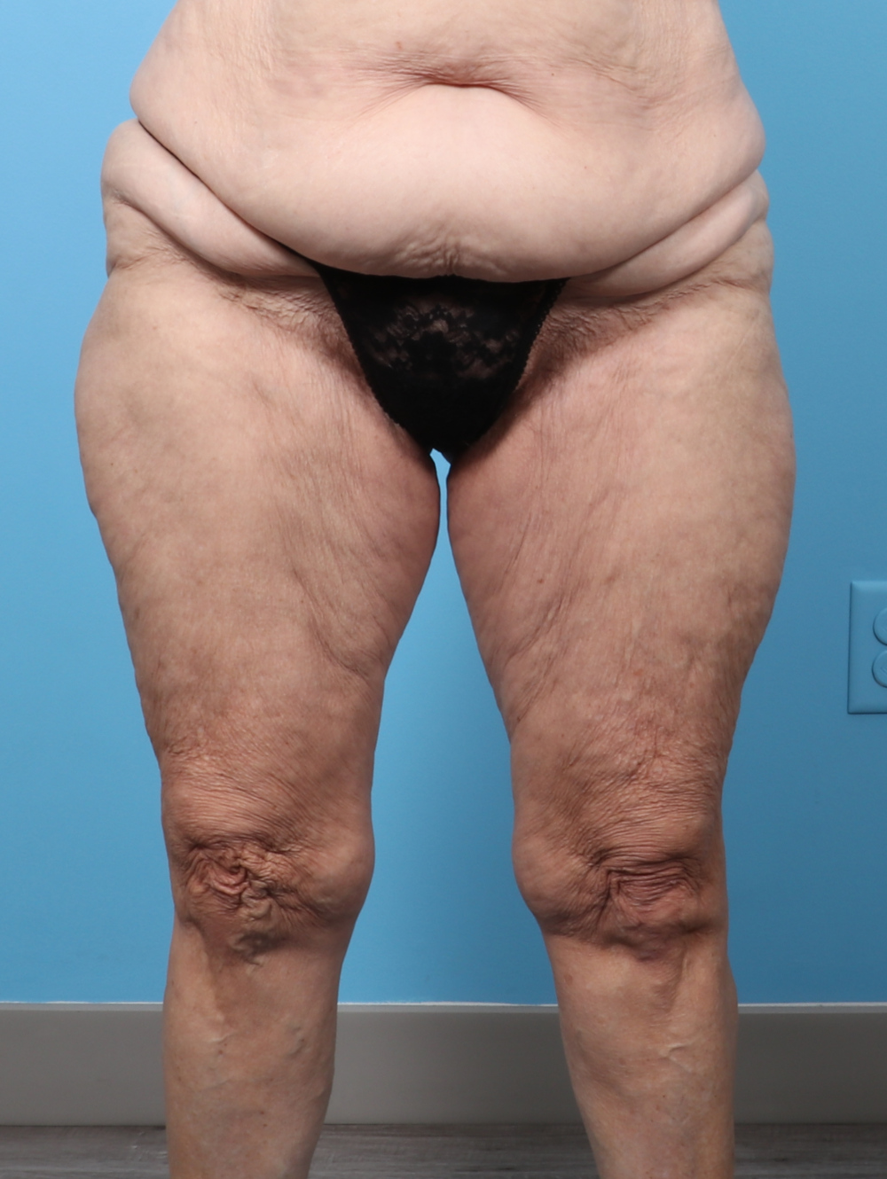 SC-THIGHLIPO-70YRS-FRONT-AFTER-edited