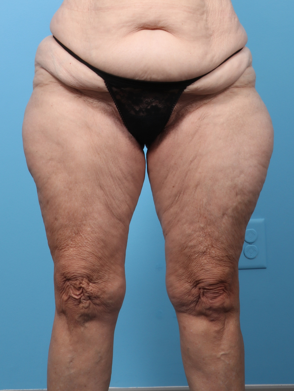 SC-THIGHLIPO-70YRS-FRONT-BEFORE-edited