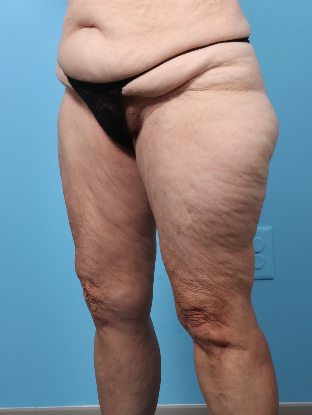 SC-THIGHLIPO-70YRS-OBL-BEFORE-edited