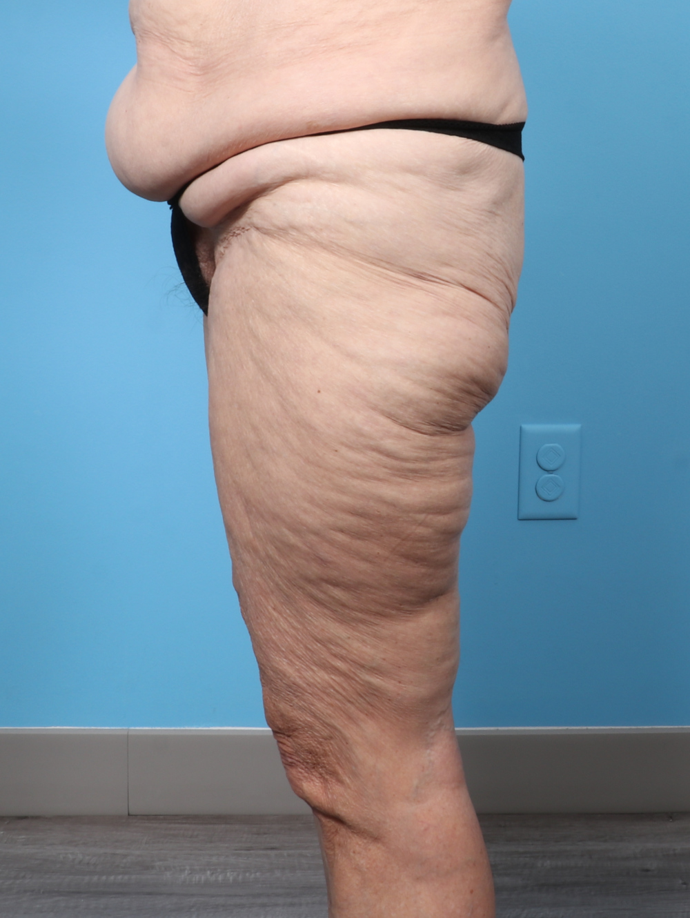 SC-THIGHLIPO-70YRS-SIDE-AFTER-edited