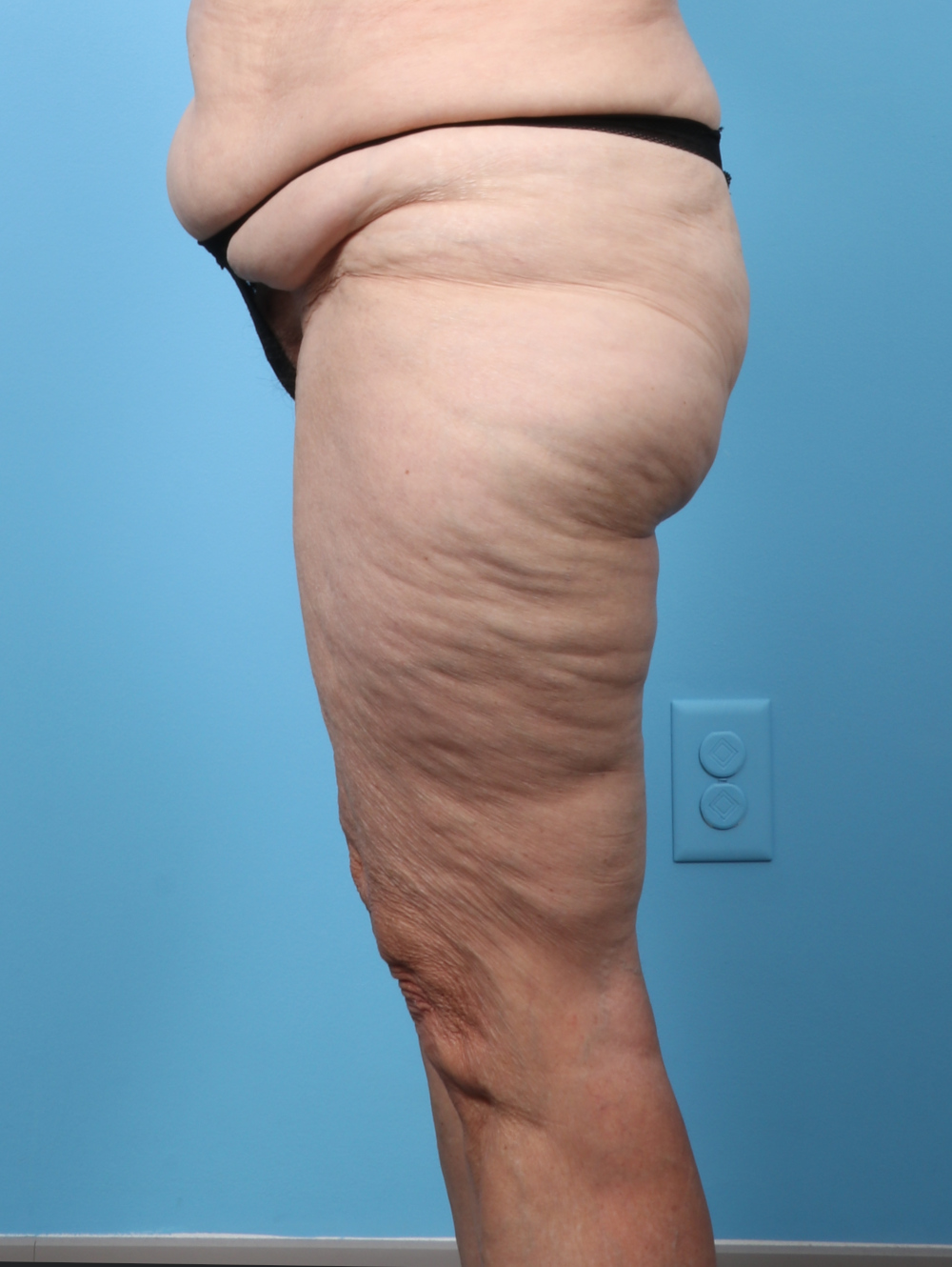 SC-THIGHLIPO-70YRS-SIDE-BEFORE-edited